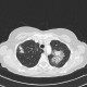 Pulmonary aspergillosis, angioinvasive aspergillosis: CT - Computed tomography