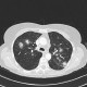 Pulmonary aspergillosis, angioinvasive aspergillosis: CT - Computed tomography