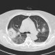 Angioinvasive aspergilosis, second CT: CT - Computed tomography