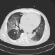 Alveolar hemorrhage, acute stage: CT - Computed tomography