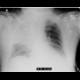 Aspiration pneumonia: X-ray - Plain radiograph