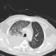 Aspiration pneumonia: CT - Computed tomography