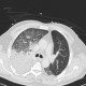 Aspiration pneumonia: CT - Computed tomography