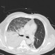 Aspiration pneumonia: CT - Computed tomography