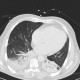 Aspiration pneumonia: CT - Computed tomography