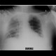 Aspiration pneumonia, healing: X-ray - Plain radiograph