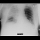 Aspiration pneumonia, healing: X-ray - Plain radiograph