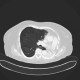 Atelectasis of left lung wing: CT - Computed tomography
