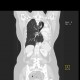 Atelectasis of left lung wing: CT - Computed tomography