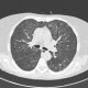 Atypical pneumonia, CMV: CT - Computed tomography