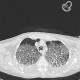 Atypical pneumonia, crazy-paving pattern: CT - Computed tomography
