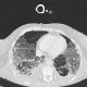 Atypical pneumonia, crazy-paving pattern: CT - Computed tomography