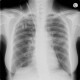 Atypical pneumonia, crazy-paving pattern: X-ray - Plain radiograph