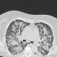 Atypical pneumonia, crazy-paving pattern, follow-up: CT - Computed tomography