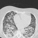 Atypical pneumonia, crazy-paving pattern, follow-up: CT - Computed tomography