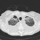 Atypical pneumonia, subacute stage, lung fibrosis: CT - Computed tomography