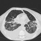 Atypical pneumonia, subacute stage, lung fibrosis: CT - Computed tomography