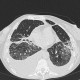 Atypical pneumonia, subacute stage, lung fibrosis: CT - Computed tomography