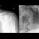 Abruption of articular surface of humeral head, osteonecrosis: X-ray - Plain radiograph