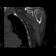 Abruption of articular surface of humeral head, osteonecrosis: CT - Computed tomography