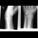 Abruption of triquetrum, transverse fracture of distal radius, abruption of unlar styloid process: X-ray - Plain radiograph