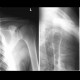 Abruption of the greater tubercle of humerus: X-ray - Plain radiograph