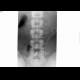 Abruption of transverse process of lumbar vertebra: X-ray - Plain radiograph