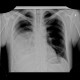 Liver abscess, large, punction, pneumothorax: X-ray - Plain radiograph