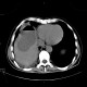 Liver abscess, large, punction, pneumothorax: CT - Computed tomography