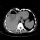 Liver abscess, large, punction, pneumothorax: CT - Computed tomography