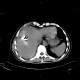 Liver abscess, large, punction, pneumothorax: CT - Computed tomography