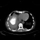 Liver abscess, large, punction, pneumothorax: CT - Computed tomography