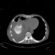 Liver abscess, large, punction, pneumothorax: CT - Computed tomography