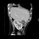 Liver abscess, large, punction, pneumothorax: CT - Computed tomography