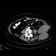 Abscess after diverticulitis, second CT: CT - Computed tomography