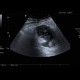 Abscess, Crohn's disease: US - Ultrasound