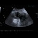 Abscess, Crohn's disease: US - Ultrasound