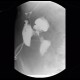 Abscess, cutaneous fistula, colonic fistula: RF - Fluoroscopy