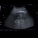 Abscess, cutaneous fistula, colonic fistula: US - Ultrasound