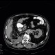 Abscess, cutaneous fistula, colonic fistula: CT - Computed tomography