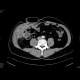 Abscesses in abdominal wall following appendectomy: CT - Computed tomography