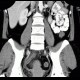 Acute appendicitis, pelvic position: CT - Computed tomography