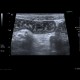 Acute enterocolitis, enteritis and colitis: US - Ultrasound