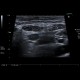 Acute colitis, inflammatory lymph nodes: US - Ultrasound