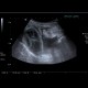 Acute gangrenous cholecystitis: US - Ultrasound