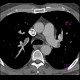 Acute lung embolism, massive: CT - Computed tomography