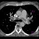 _fetch_thumbnail.php?img=Acute%20lung%20embolism.CT.2_0001.jpg
