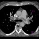 Acute lung embolism, massive: CT - Computed tomography