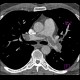 Acute lung embolism, massive: CT - Computed tomography