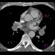 Acute lung embolism, massive: CT - Computed tomography